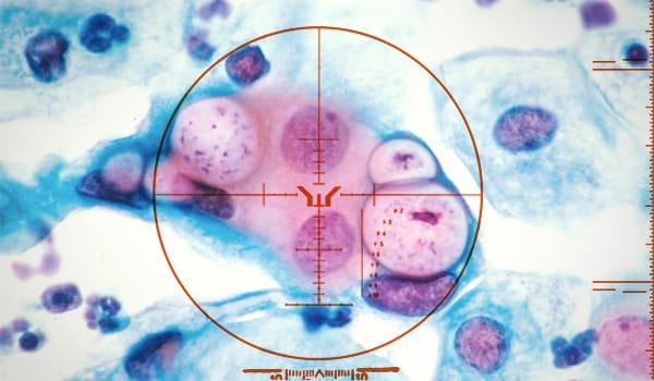 All What You Need To Know About Chlamydia Image