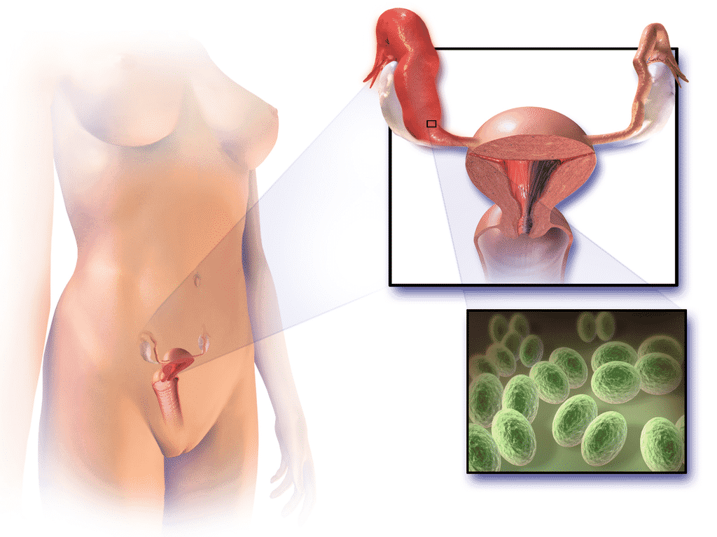 Sexually Transmitted Disease-Causing PID “Pelvic Inflammatory Disease” Image
