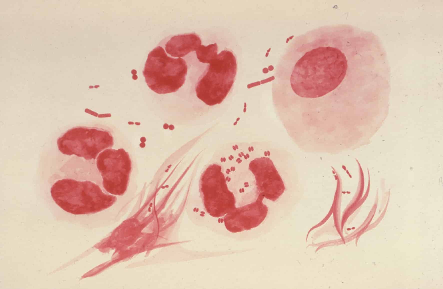 How the Throat Becomes a "Silent Vessel" for Gonorrhoea Image