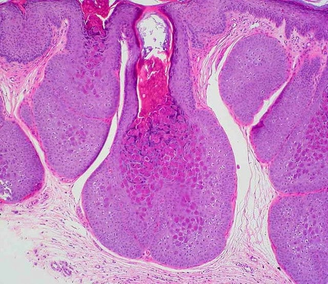 Molluscum Contagiosum Image