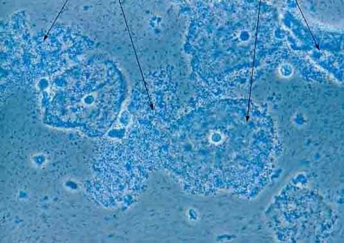 BV Bacterial Species in the Vaginal Flora Could Make African Women Vulnerable to HIV Image